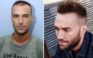 Calum Best Hair transplant