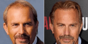 Kevin Costner hair transplant