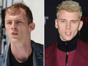 Machine Gun Kelly (MGK) hair transplant
