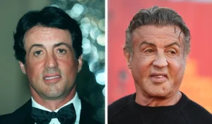 Sylvester Stallone Hair transplant