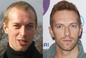 Chris Martin hair transplant