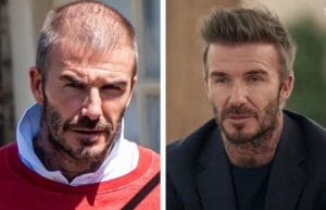 david beckham hair transplant