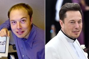 Elon Musk Hair Transplant