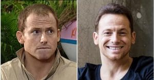 Joe Swash hair transplant