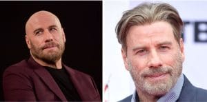 John Travolta hair transplant