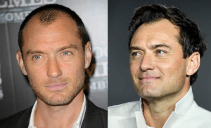Jude Law Hair transplant