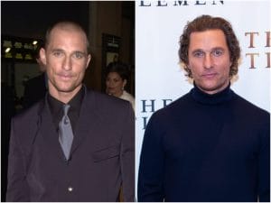 Matthew McConaughey hair transplant