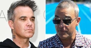 Robbie Williams hair transplant