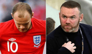 wayne rooney hair transplant