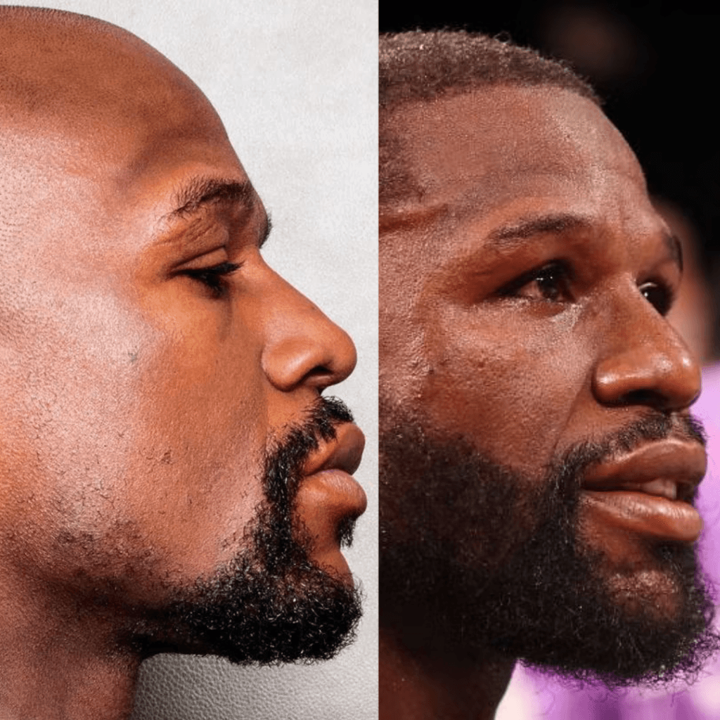 Floyd Mayweather​ Beard Transplant After Before