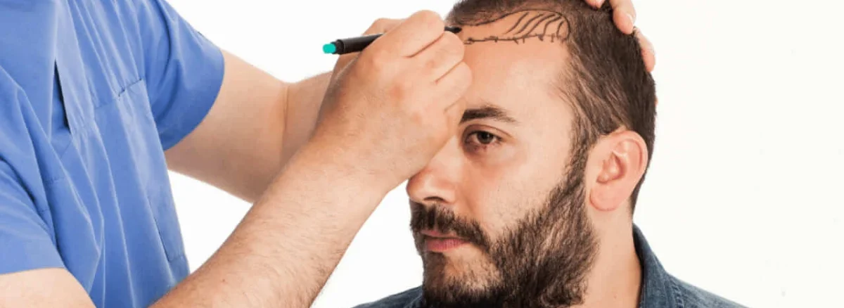 Turkey Hair Transplant Packages