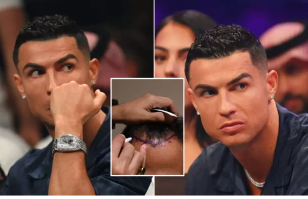 Cristiano Ronaldo Hair Transplant