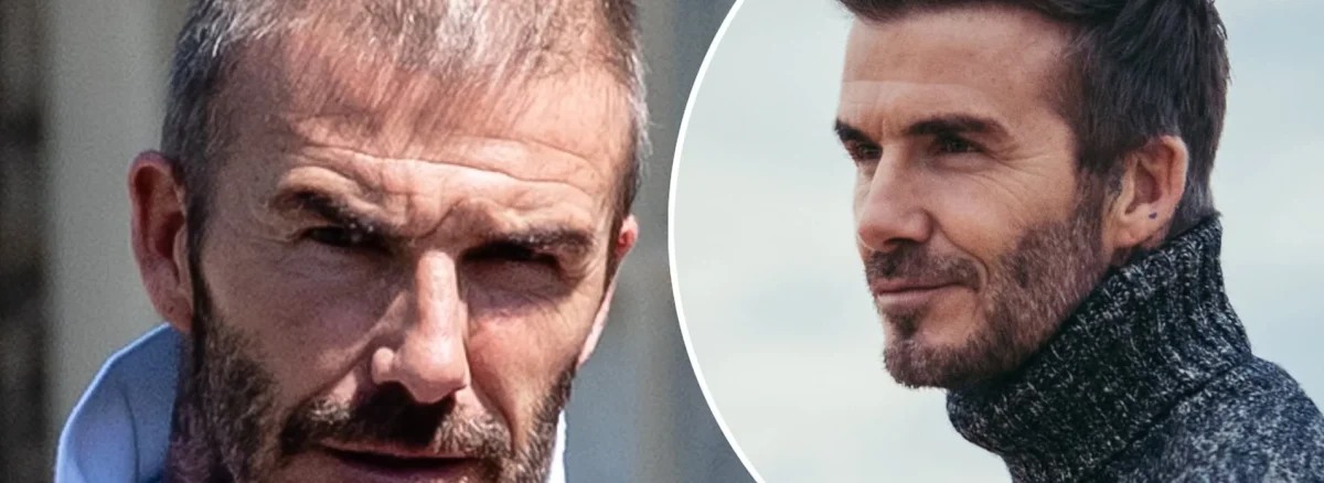 David Beckham Hair Transplant