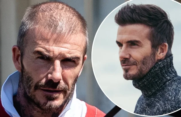 David Beckham Hair Transplant