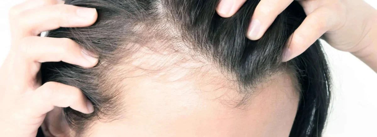 Female Hair Transplant in Turkey