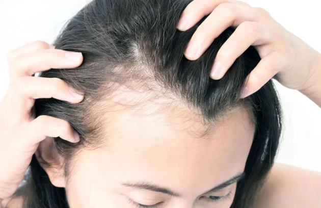Female Hair Transplant in Turkey