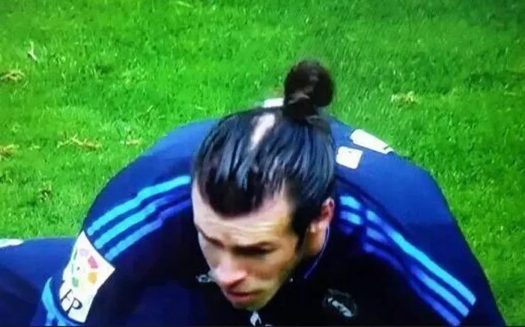 Gareth Bale Hair Transplant