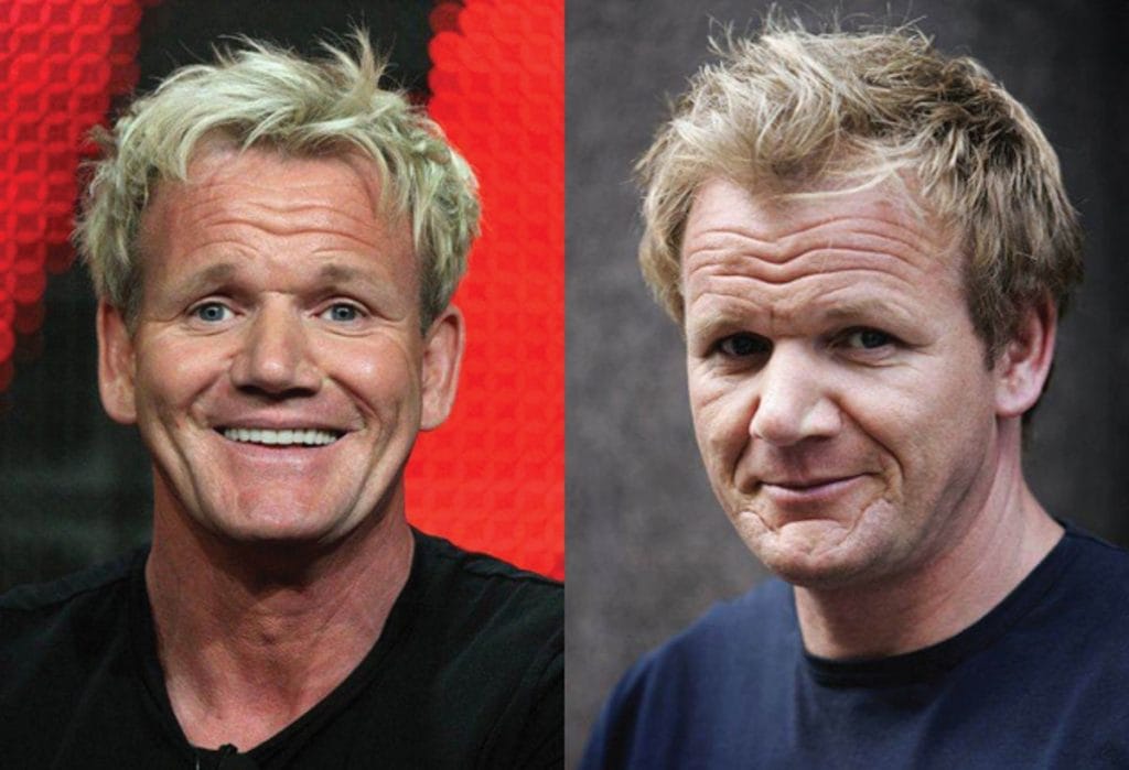 Gordon Ramsay Hair Transplant