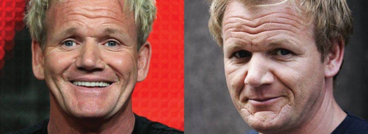 Gordon Ramsay Hair Transplant