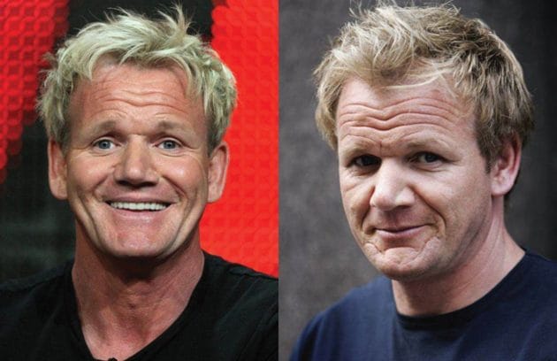Gordon Ramsay Hair Transplant