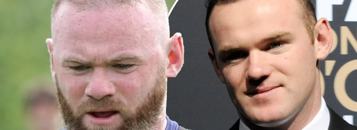 Wayne Rooney Hair Transplant