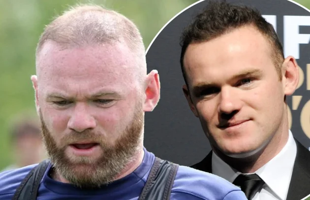 Wayne Rooney Hair Transplant