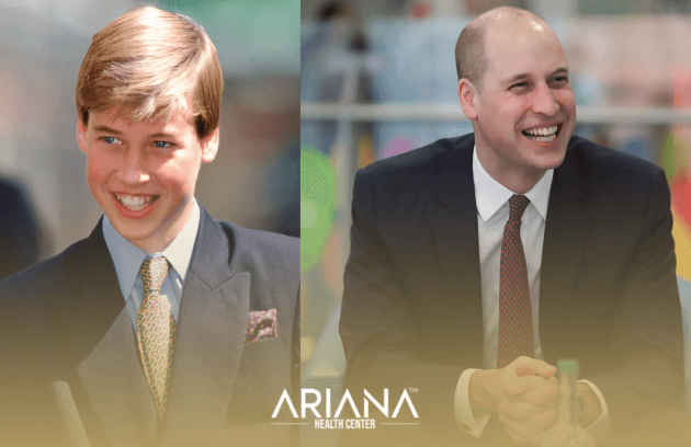 Prince William’s Hair Loss